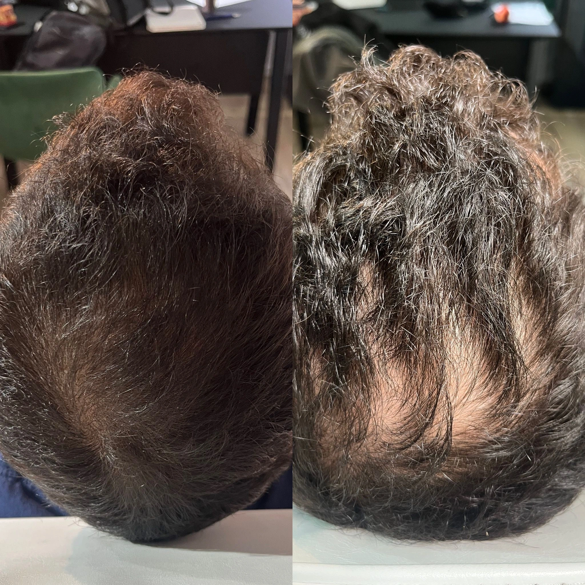 לפני ואחרי טיפול — תוצאה קלינית אמיתית