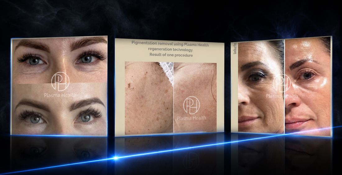 Plasma Health - Before & After: עיניים, פיגמנטציה, קמטים