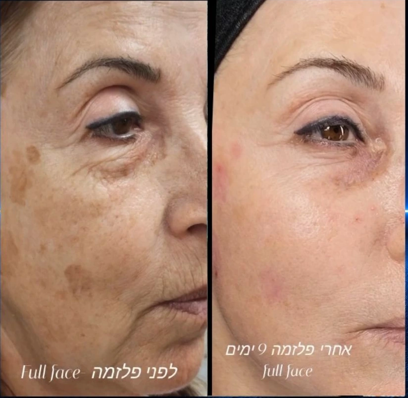 טיפול Full Face - לפני פלזמה ואחרי 9 ימים