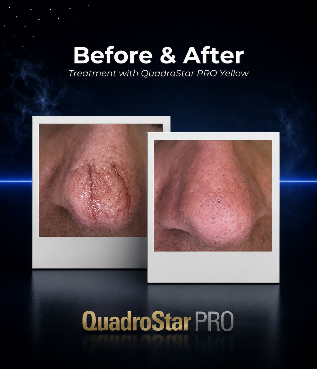 QuadroStar PRO - Before & After Treatment Yellow
