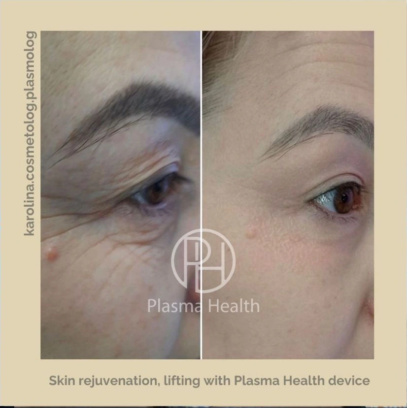 מיצוק ועדנת עור - לפני ואחרי טיפול Plasma Health