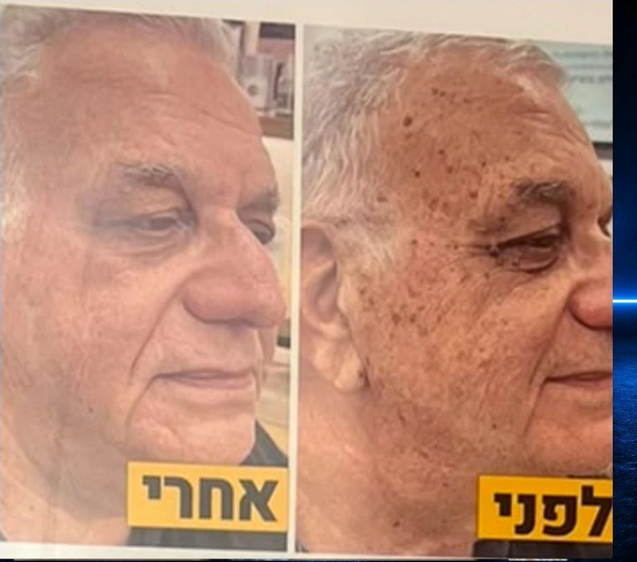 הבהרת פיגמנטציה - לפני ואחרי טיפול Plasma Health