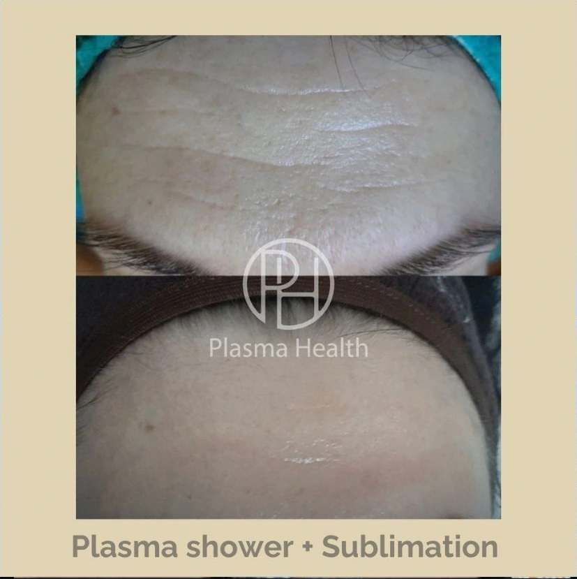החלקת קמטי מצח - Plasma Shower + Sublimation